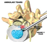 Annular Tear Diagram