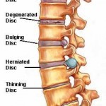 Degenerative Disc Disease