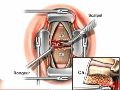 cervical-fusion-surgery