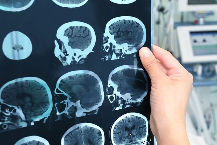 Traumatic Brain Injury And The Value Of Your Personal Injury Case in Oregon